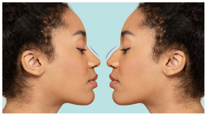 Could Rhinoplasty in Dubai Be the Change Your Face Needs?